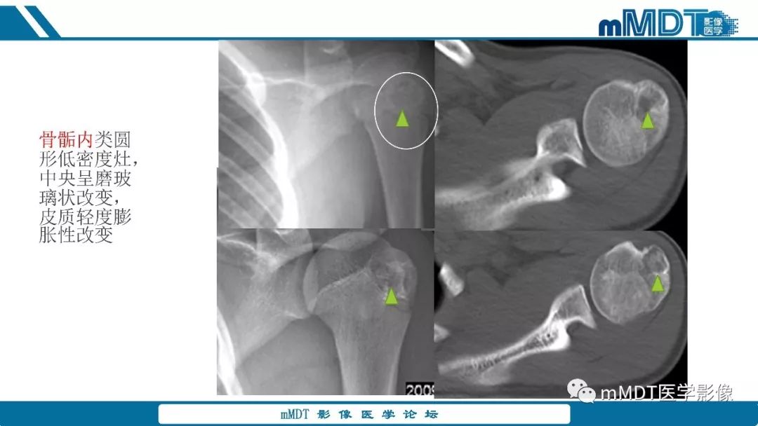 【PPT】成软骨性骨肿瘤影像诊断