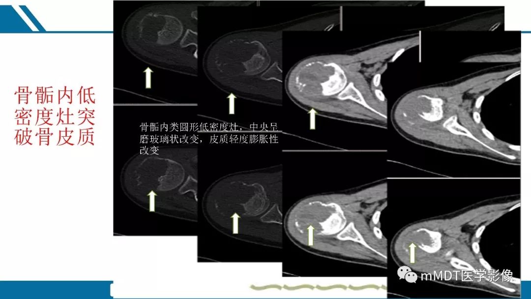 【PPT】成软骨性骨肿瘤影像诊断