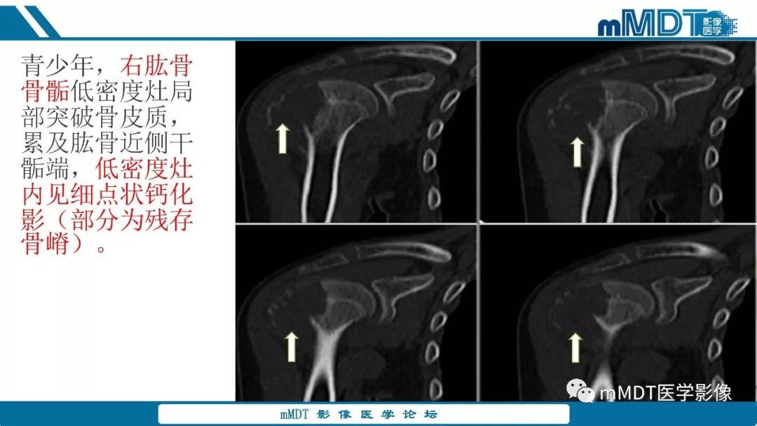 【PPT】成软骨性骨肿瘤影像诊断
