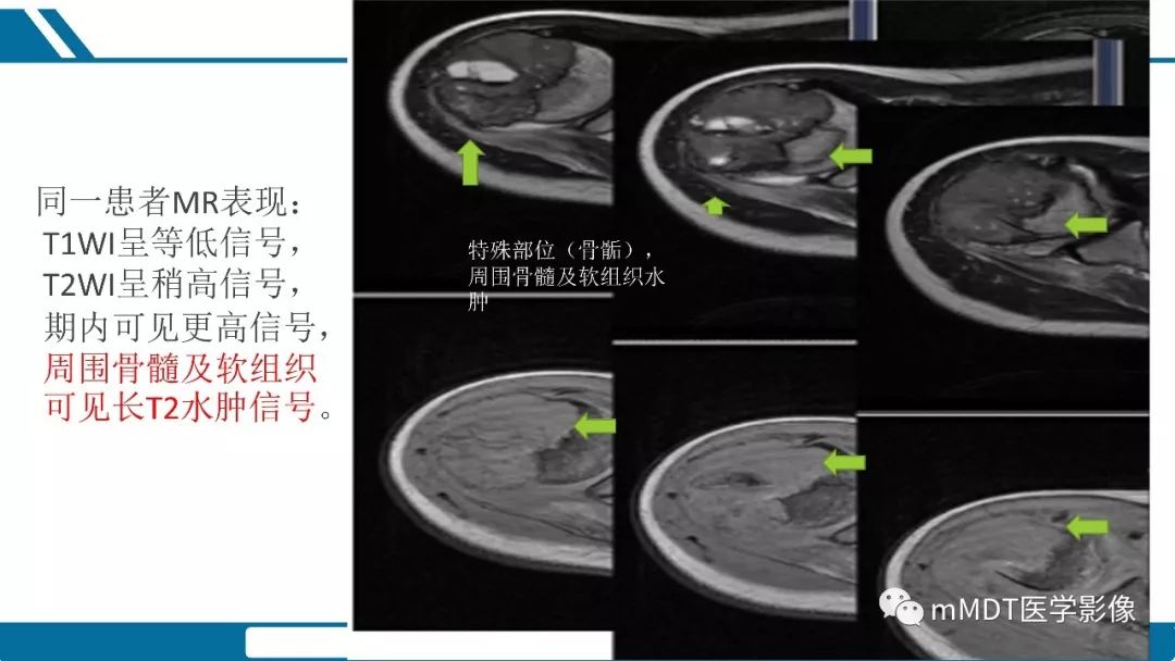 【PPT】成软骨性骨肿瘤影像诊断