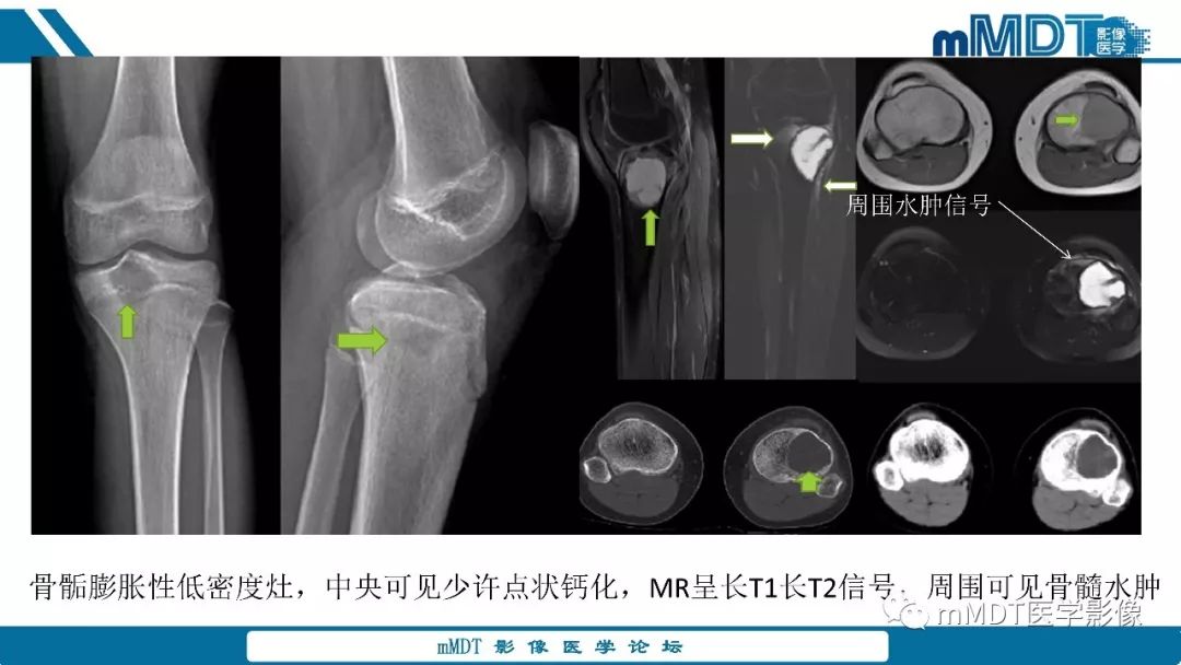 【PPT】成软骨性骨肿瘤影像诊断
