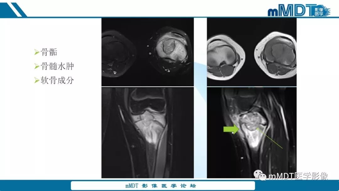 【PPT】成软骨性骨肿瘤影像诊断