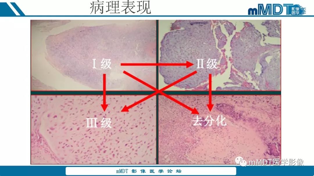 【PPT】成软骨性骨肿瘤影像诊断