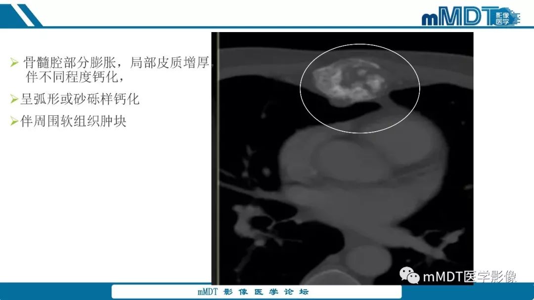 【PPT】成软骨性骨肿瘤影像诊断