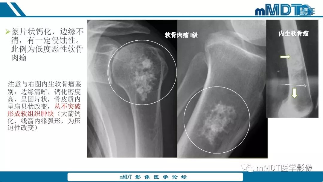 【PPT】成软骨性骨肿瘤影像诊断