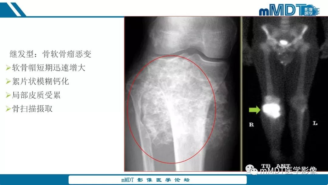 【PPT】成软骨性骨肿瘤影像诊断