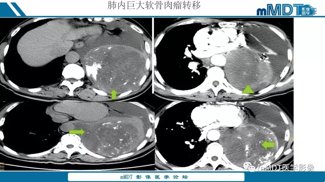 【PPT】成软骨性骨肿瘤影像诊断