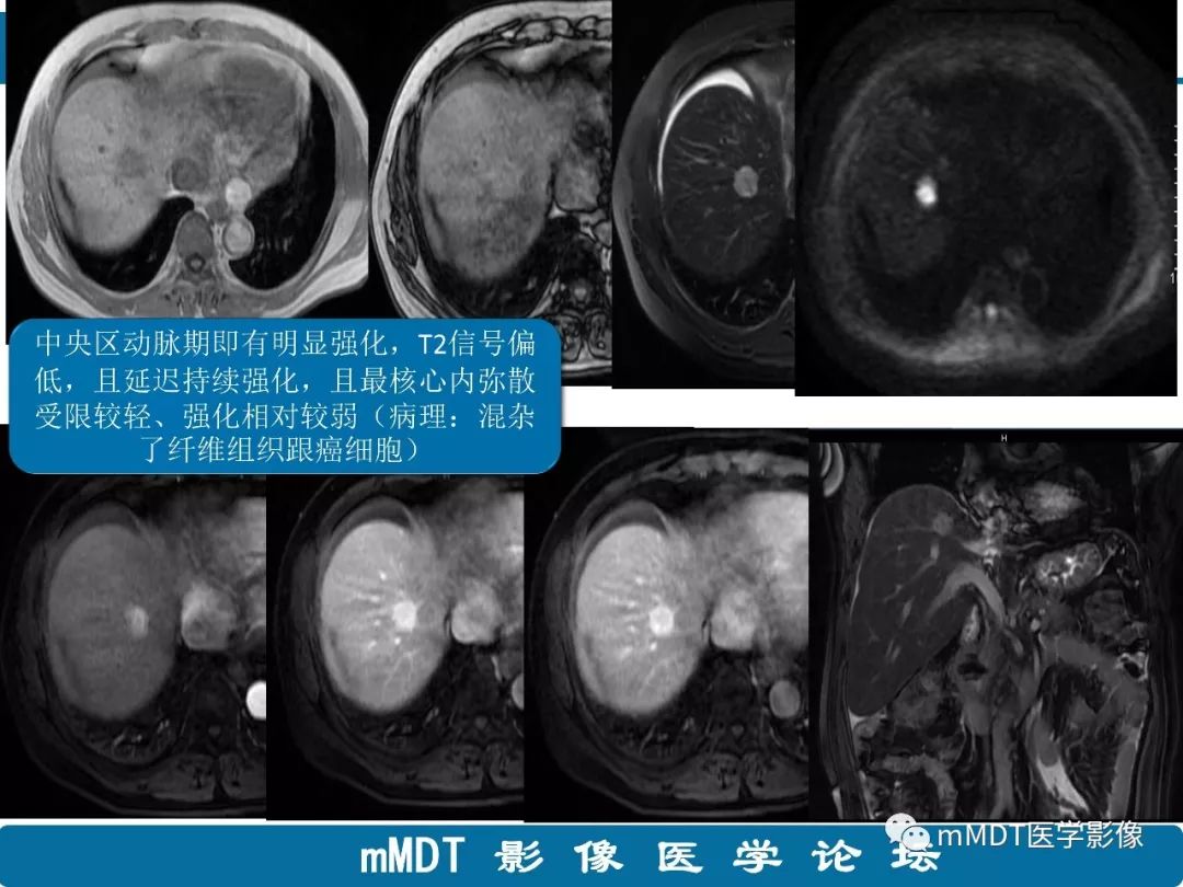 【病例】明显强化的肝内胆管细胞癌1例