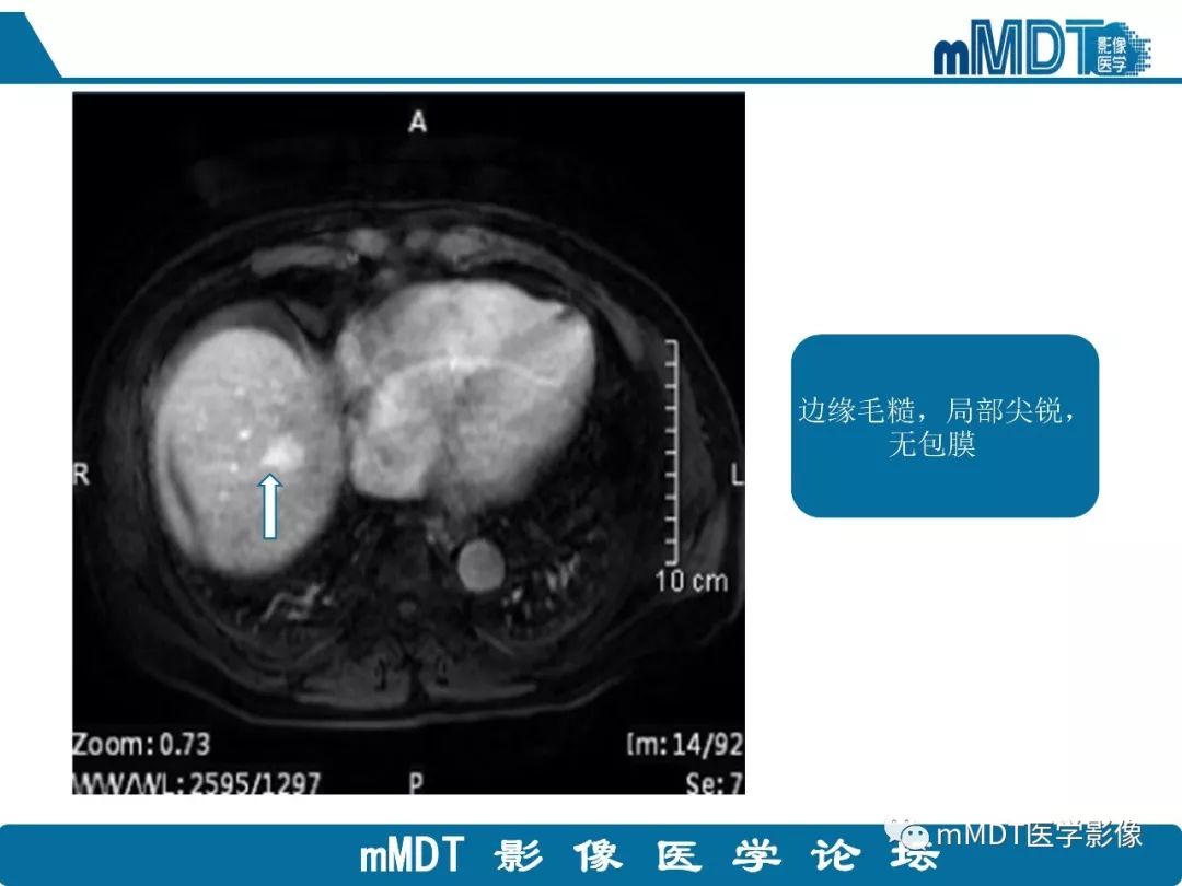 【病例】明显强化的肝内胆管细胞癌1例
