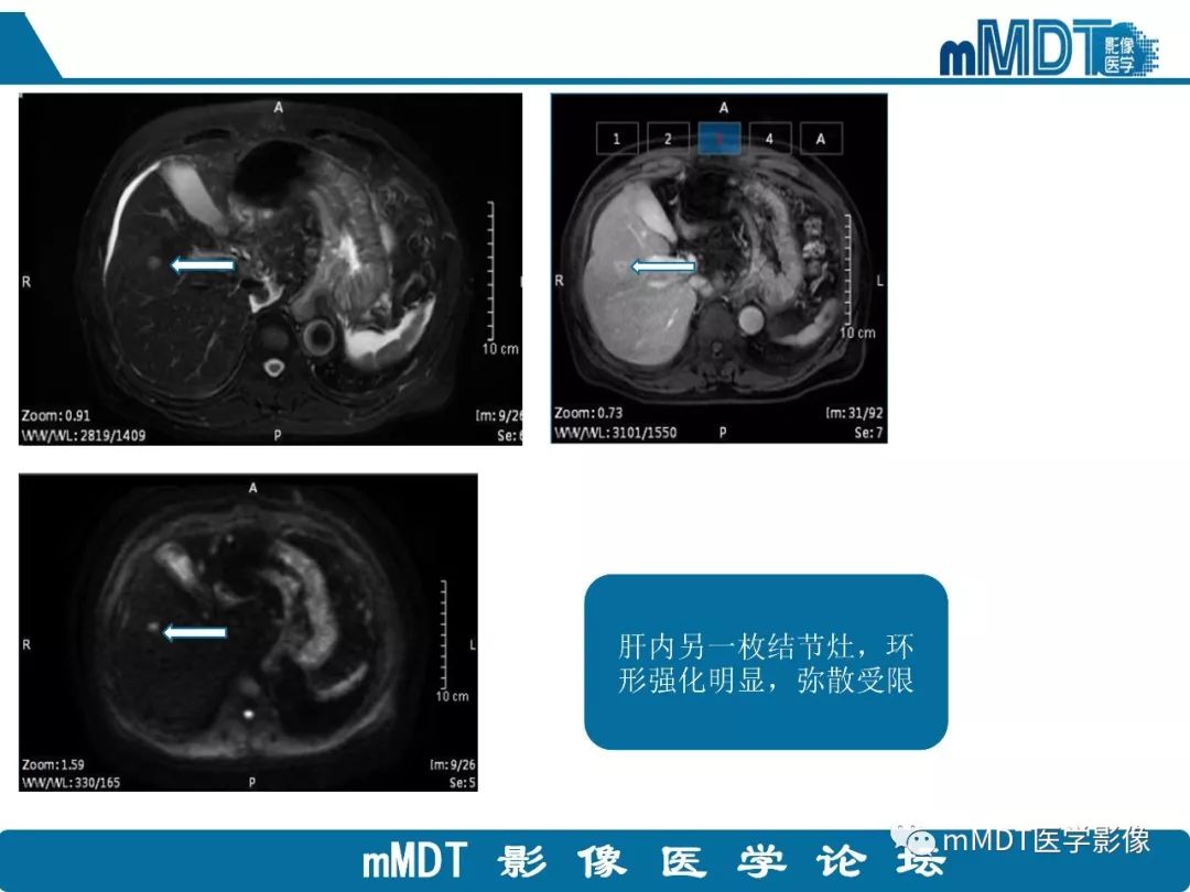 【病例】明显强化的肝内胆管细胞癌1例
