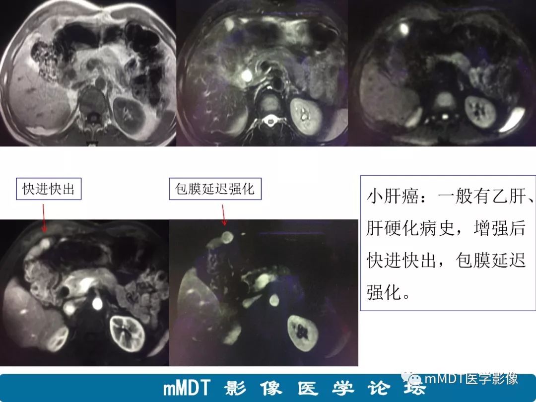 【病例】明显强化的肝内胆管细胞癌1例