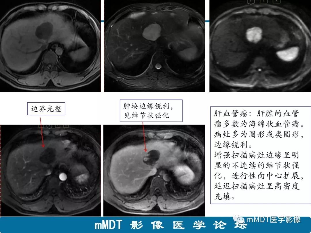 【病例】明显强化的肝内胆管细胞癌1例