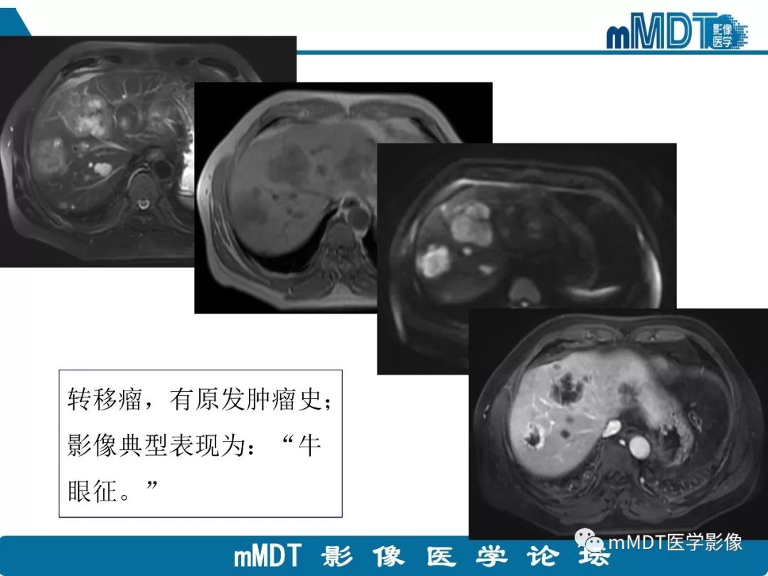 【病例】明显强化的肝内胆管细胞癌1例