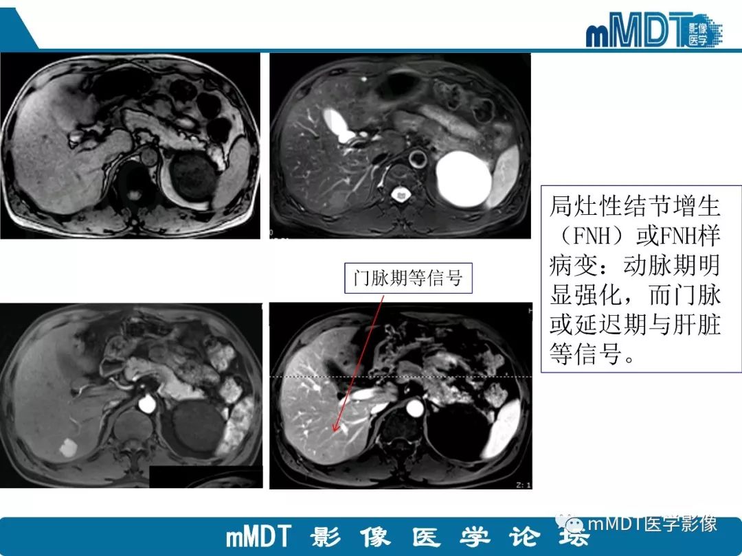 【病例】明显强化的肝内胆管细胞癌1例