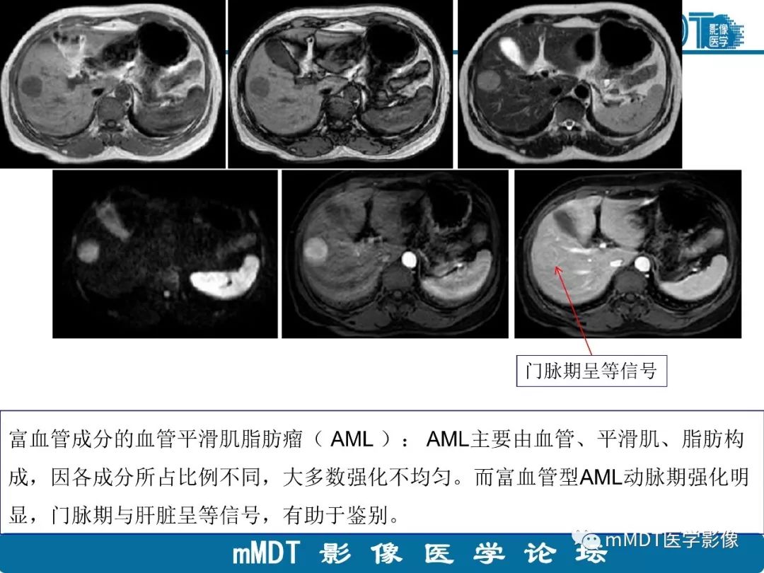 【病例】明显强化的肝内胆管细胞癌1例