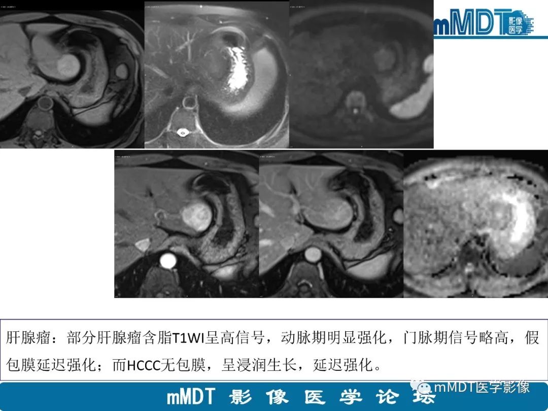 【病例】明显强化的肝内胆管细胞癌1例