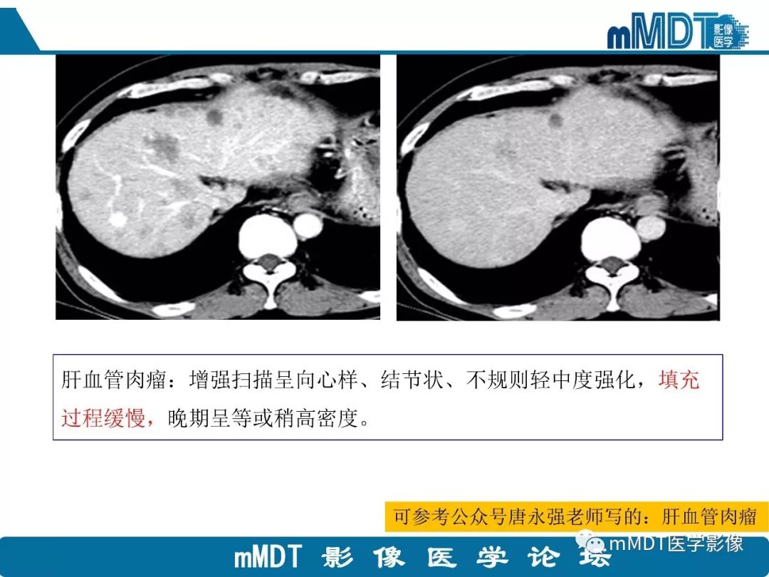 【病例】明显强化的肝内胆管细胞癌1例