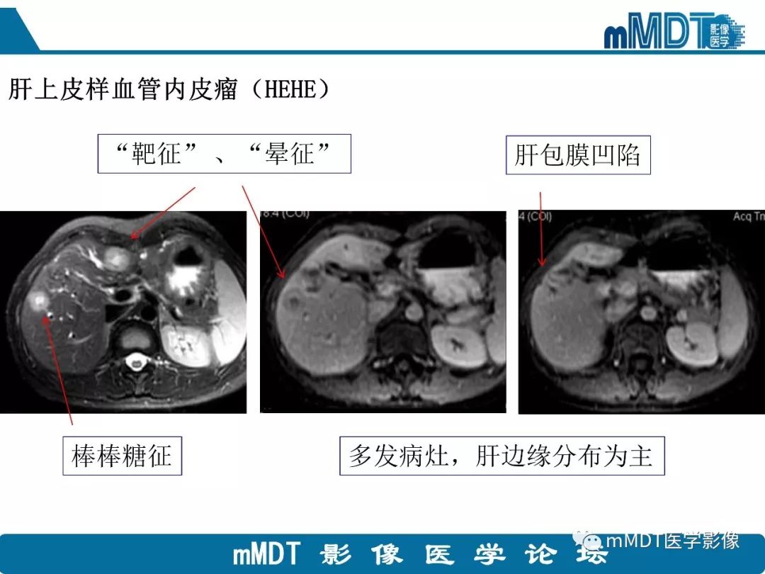 【病例】明显强化的肝内胆管细胞癌1例