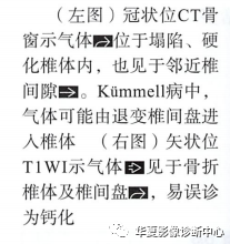 kummell病——外伤后椎体缺血坏死