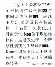 kummell病——外伤后椎体缺血坏死