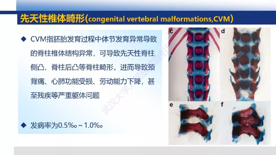 【PPT】先天性椎体畸形影像诊断