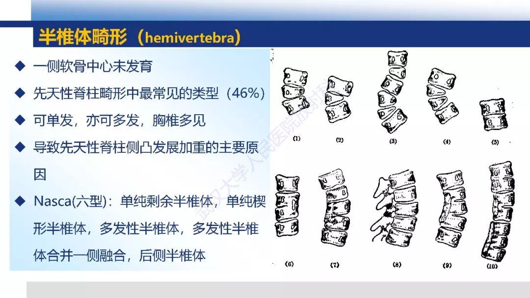 【PPT】先天性椎体畸形影像诊断