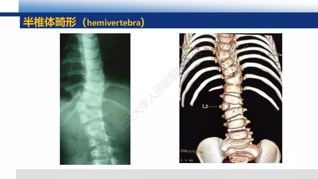 【PPT】先天性椎体畸形影像诊断