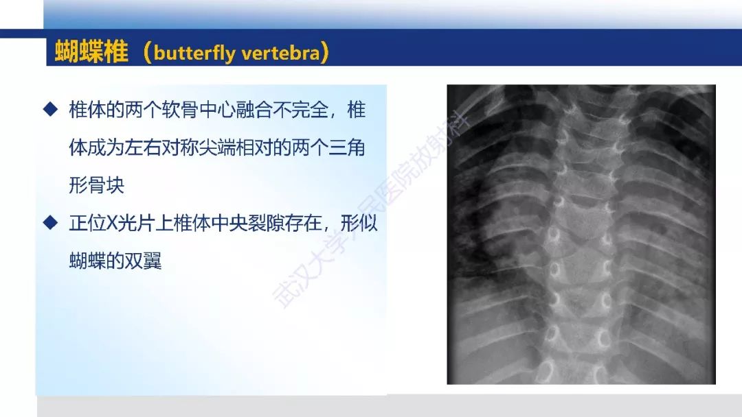 【PPT】先天性椎体畸形影像诊断