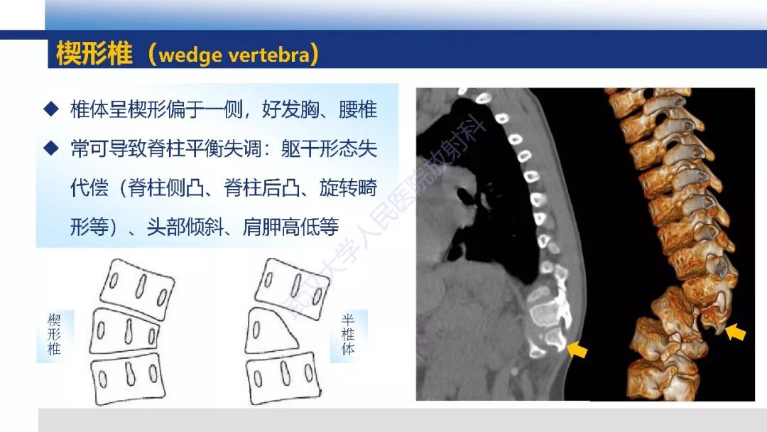 【PPT】先天性椎体畸形影像诊断