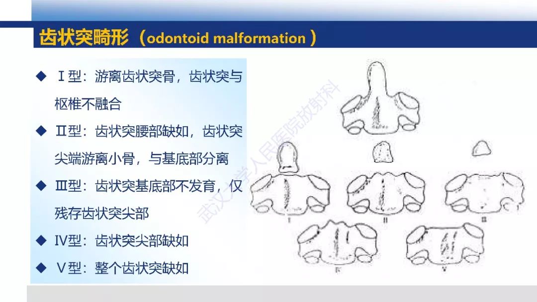 【PPT】先天性椎体畸形影像诊断