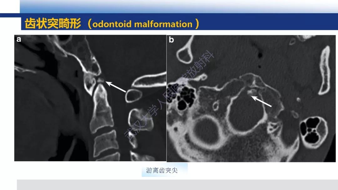 【PPT】先天性椎体畸形影像诊断