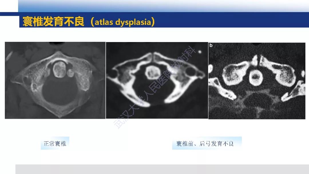 【PPT】先天性椎体畸形影像诊断