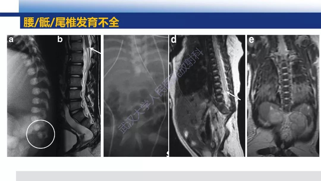 【PPT】先天性椎体畸形影像诊断