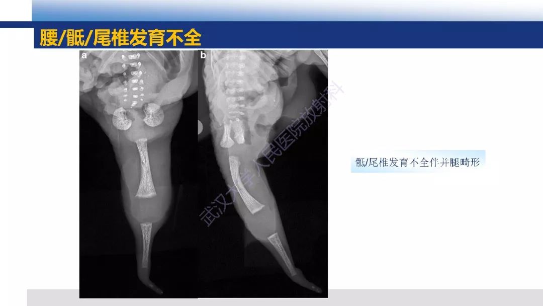 【PPT】先天性椎体畸形影像诊断