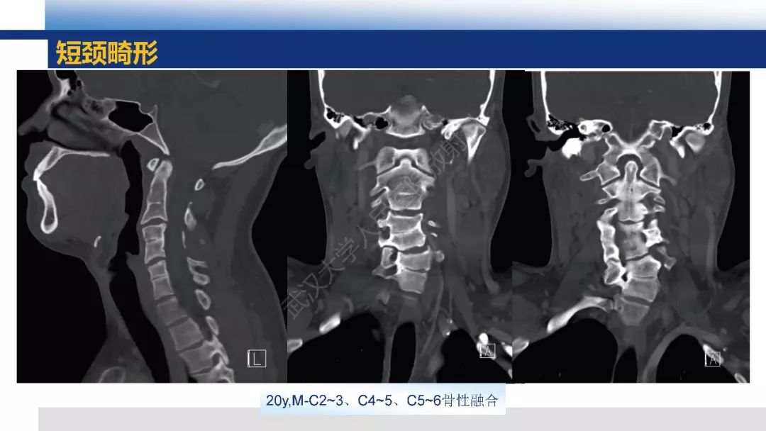 【PPT】先天性椎体畸形影像诊断