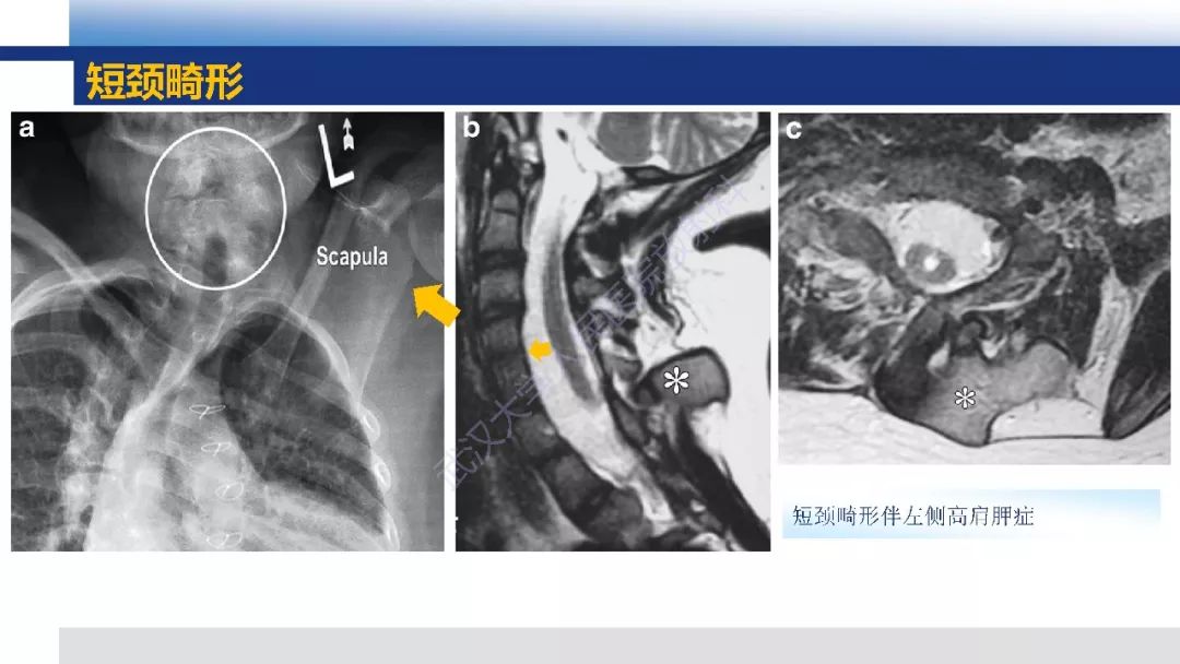 【PPT】先天性椎体畸形影像诊断