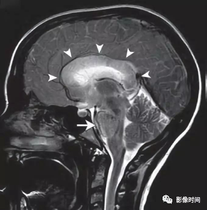 为了减肥，她们喝出了中毒性白质脑病