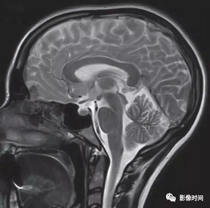 为了减肥,她们喝出了中毒性白质脑病 为了减肥,她们喝出了中毒性白质脑病