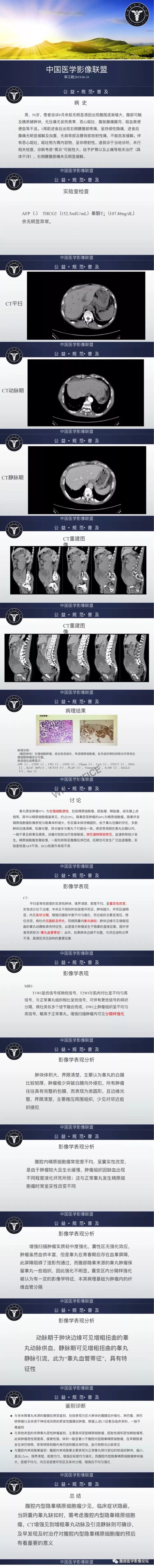 【病例】腹腔肿块精原细胞瘤1例CT影像表现