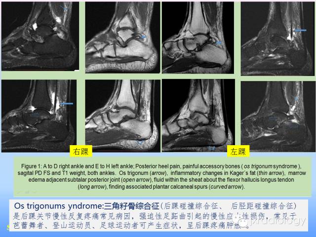 【PPT】足跟痛的MRI表现