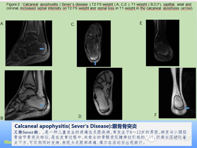 【PPT】足跟痛的MRI表现