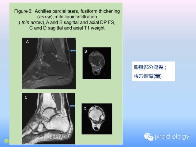 【PPT】足跟痛的MRI表现