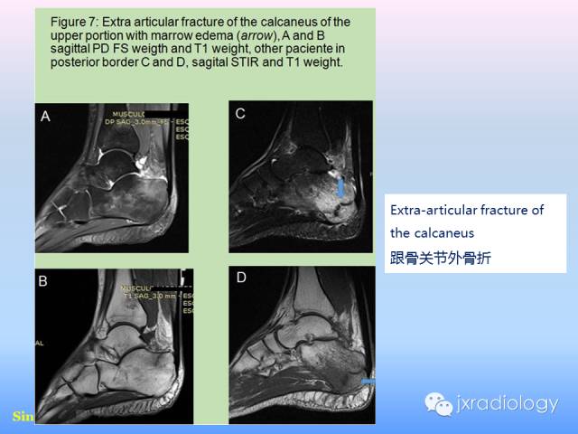 【PPT】足跟痛的MRI表现