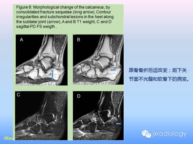 【PPT】足跟痛的MRI表现