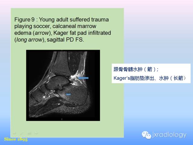 【PPT】足跟痛的MRI表现