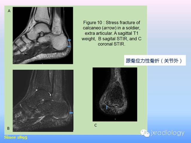 【PPT】足跟痛的MRI表现