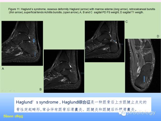 【PPT】足跟痛的MRI表现