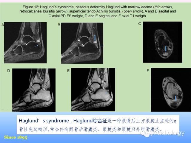 【PPT】足跟痛的MRI表现