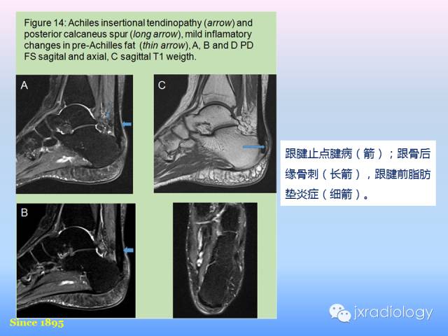 【PPT】足跟痛的MRI表现