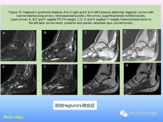 【PPT】足跟痛的MRI表现